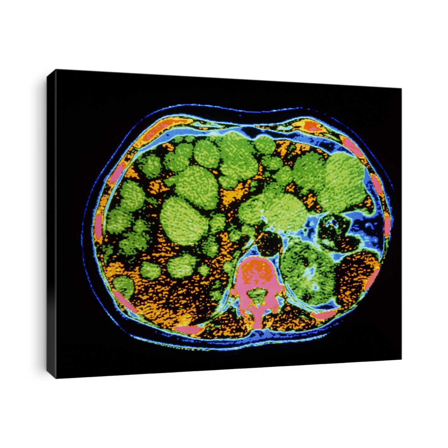 Liver cysts. False-colour computed tomography (CT) scan of an axial section through the abdomen, showing polycystic disease of the liver. Cysts (green) can be seen at upper frame, affecting a large area of the liver lobes (yellow) beneath. The liver stretches from upper right to lower left; at lower centre is a vertebra (red). Poly- cystic liver disease may occur due to infection, or it may have a genetic basis. The cysts grow gradually, destroying liver tissue. It may cause liver inadequacy and in severe cases, as here, may lead to liver failure. Polycystic disease occurs more commonly in other body organs such as the kidneys and the female ovaries.