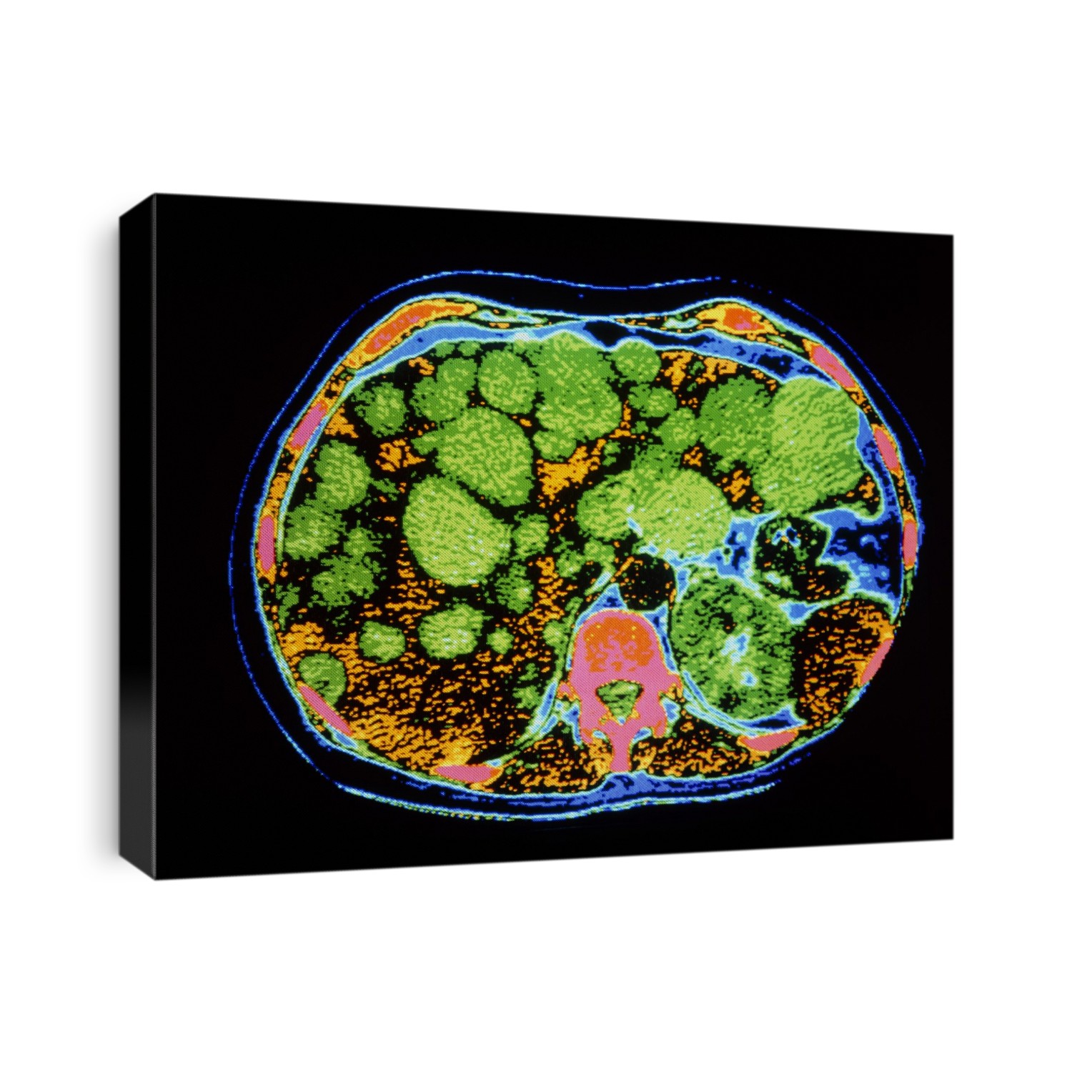 Liver cysts. False-colour computed tomography (CT) scan of an axial section through the abdomen, showing polycystic disease of the liver. Cysts (green) can be seen at upper frame, affecting a large area of the liver lobes (yellow) beneath. The liver stretches from upper right to lower left; at lower centre is a vertebra (red). Poly- cystic liver disease may occur due to infection, or it may have a genetic basis. The cysts grow gradually, destroying liver tissue. It may cause liver inadequacy and in severe cases, as here, may lead to liver failure. Polycystic disease occurs more commonly in other body organs such as the kidneys and the female ovaries.