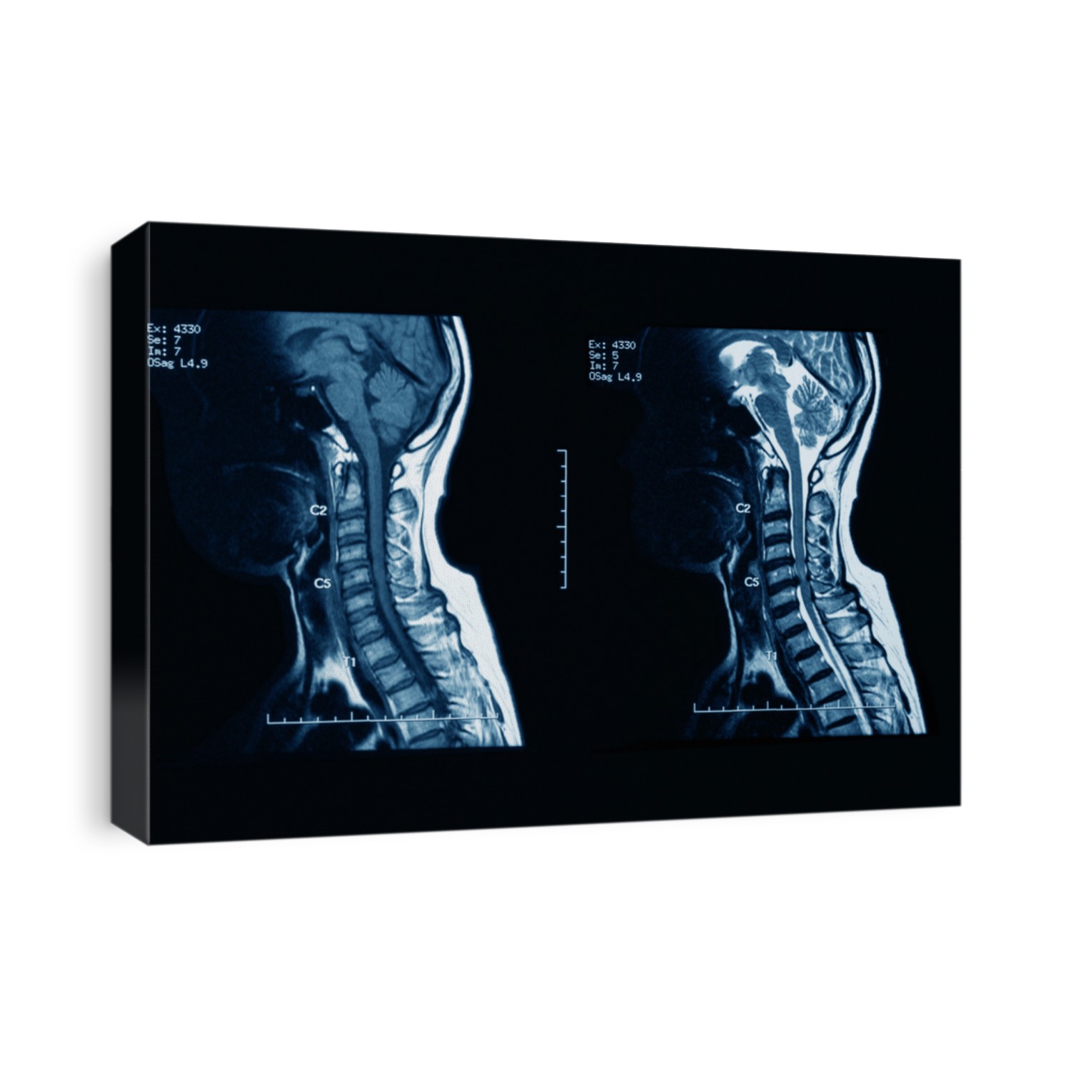 MRI scans of the cervical spine, with and without contrast media, MRI with bilateral C7 nerve root compression, Cervical spondylosis.